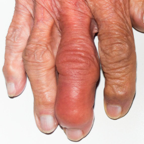Home Remedies for Gout and Gouty Arthritis