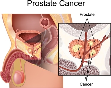 Natural Cures for Prostate Cancer That Get Powerful Results