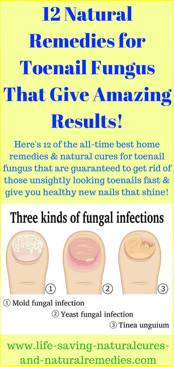 12 Home Remedies for Toenail Fungus That Give Amazing Results!