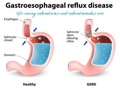Wow! 10 Fast-Relief Home Remedies for Acid Reflux &amp; Heartburn