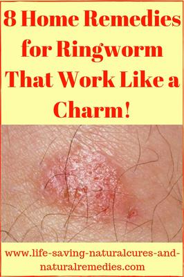 Wow! 8 Awesome (& Fast-Acting) Home Remedies for Ringworm...