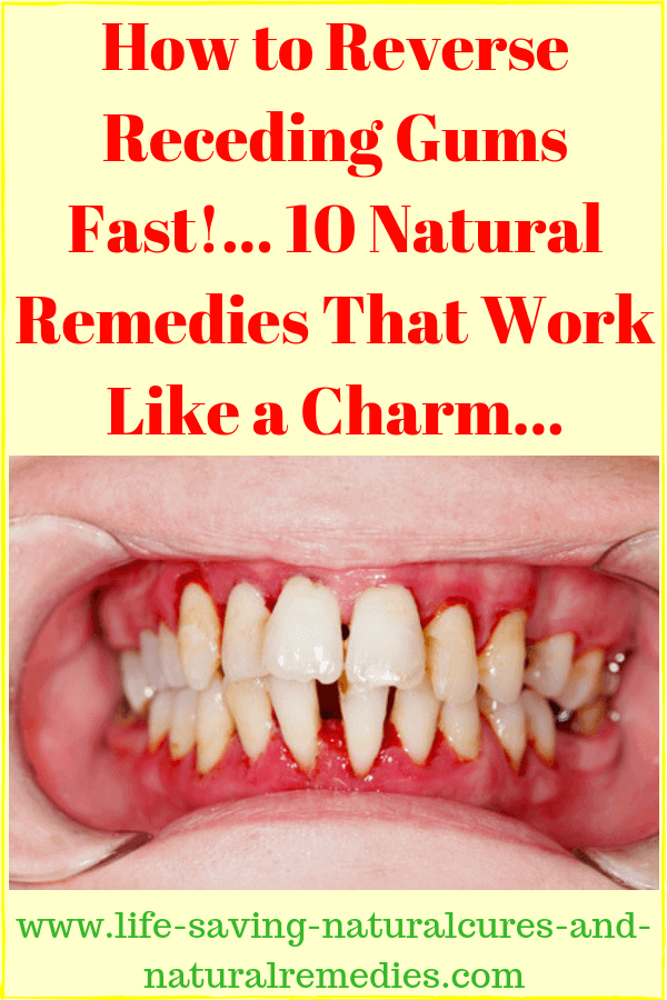 Wow! 8 Stunning Natural Remedies for Receding Gums...
